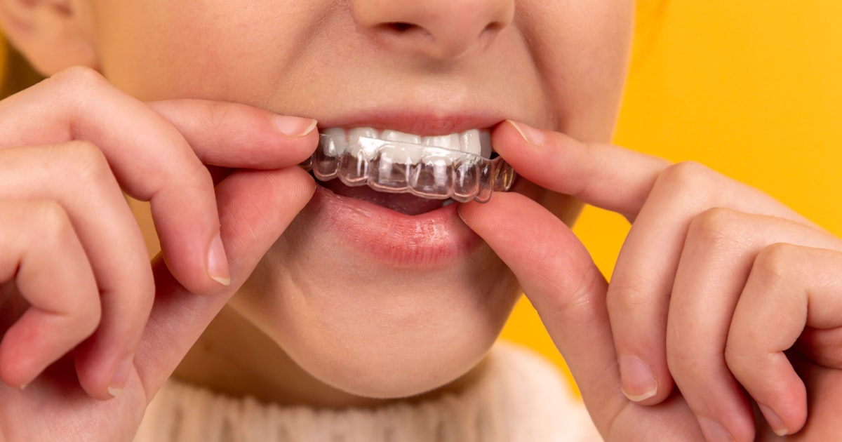 Guide to Dental Implants